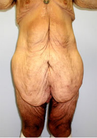 Buttock Lift Before & After Image