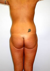 Buttock Lift Before & After Image