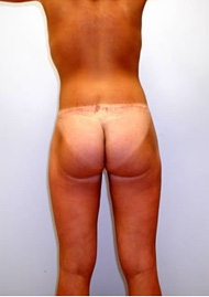 Buttock Lift Before & After Image