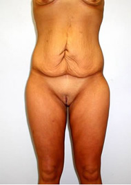 Buttock Lift Before & After Image