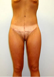 Buttock Lift Before & After Image