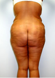 Buttock Lift Before & After Image