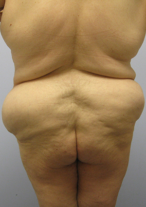 Buttock Lift Before & After Image