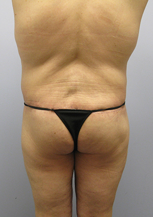 Buttock Lift Before & After Image