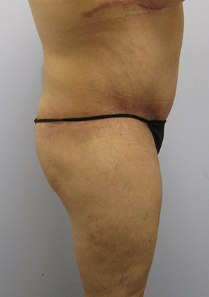 Buttock Lift Before & After Image