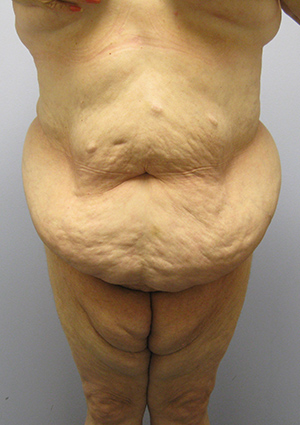 Buttock Lift Before & After Image