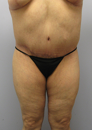 Buttock Lift Before & After Image