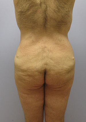 Buttock Lift Before & After Image