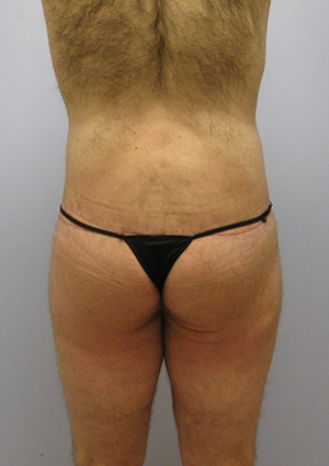 Buttock Lift Before & After Image