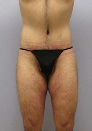 Buttock Lift Before & After Image