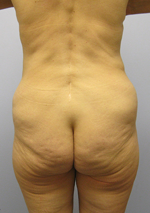 Buttock Lift Before & After Image