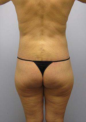 Buttock Lift Before & After Image