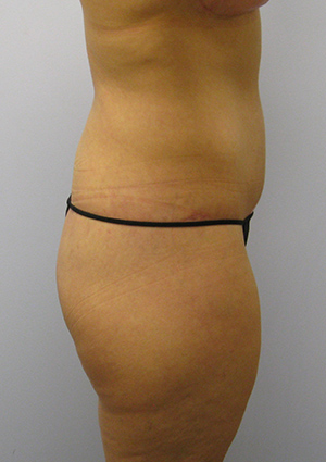 Buttock Lift Before & After Image