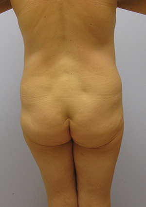 Buttock Lift Before & After Image