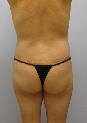 Buttock Lift Before & After Image