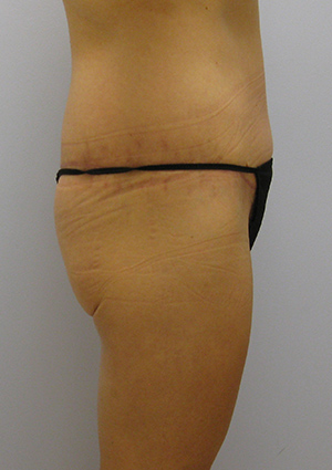 Buttock Lift Before & After Image