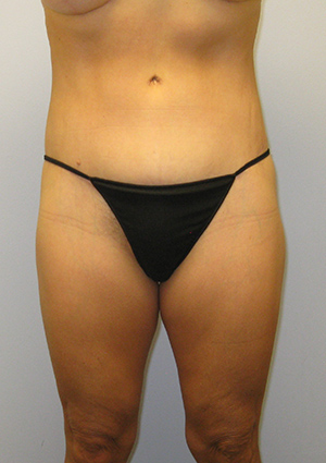 Buttock Lift Before & After Image