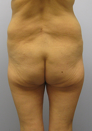 Buttock Lift Before & After Image