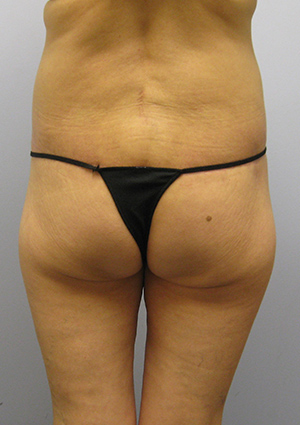 Buttock Lift Before & After Image