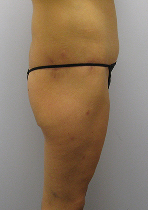 Buttock Lift Before & After Image