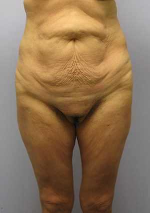 Buttock Lift Before & After Image