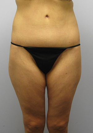 Buttock Lift Before & After Image