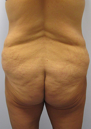 Buttock Lift Before & After Image