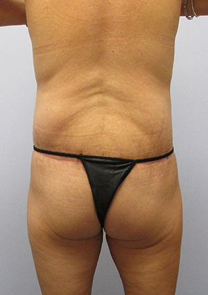 Buttock Lift Before & After Image