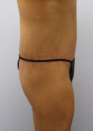 Buttock Lift Before & After Image