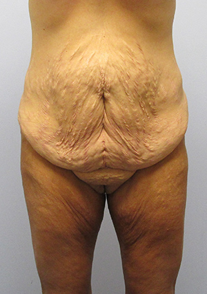 Buttock Lift Before & After Image