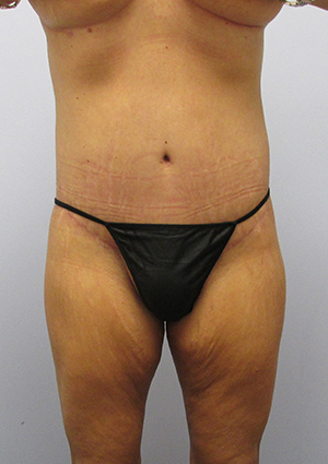 Buttock Lift Before & After Image