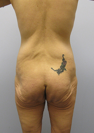 Buttock Lift Before & After Image