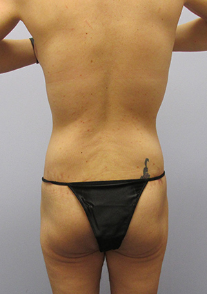 Buttock Lift Before & After Image