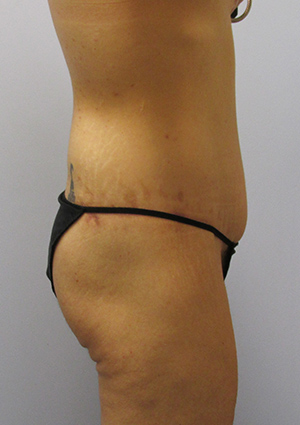 Buttock Lift Before & After Image