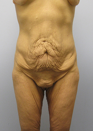 Buttock Lift Before & After Image