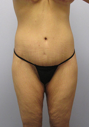 Buttock Lift Before & After Image