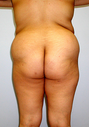 Buttock Lift Before & After Image