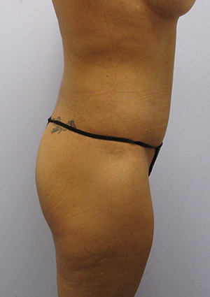 Buttock Lift Before & After Image