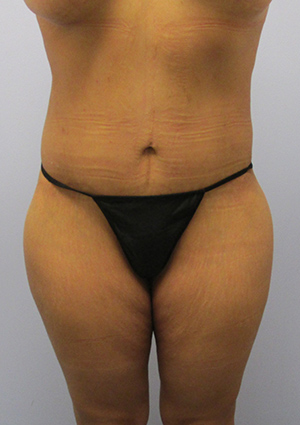 Buttock Lift Before & After Image