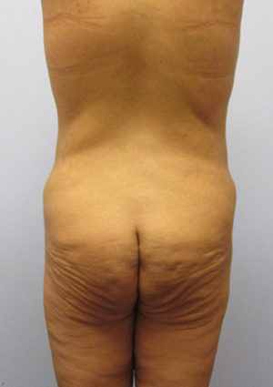 Buttock Lift Before & After Image