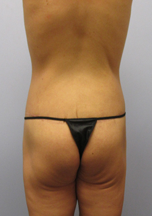 Buttock Lift Before & After Image