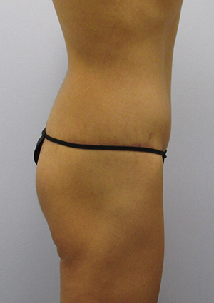 Buttock Lift Before & After Image