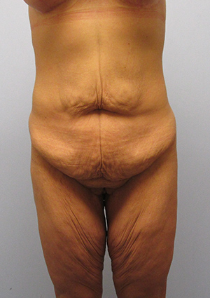 Buttock Lift Before & After Image