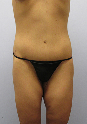 Buttock Lift Before & After Image