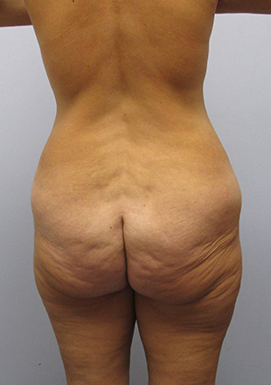 Buttock Lift Before & After Image