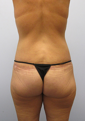 Buttock Lift Before & After Image