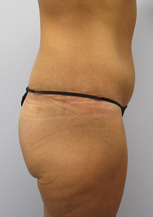 Buttock Lift Before & After Image