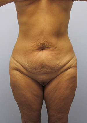 Buttock Lift Before & After Image