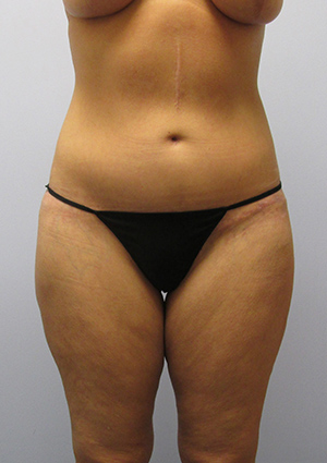 Buttock Lift Before & After Image