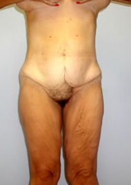 Buttock Lift Before & After Image